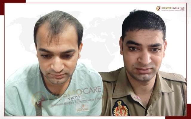 Before hair transplant, receding hairline